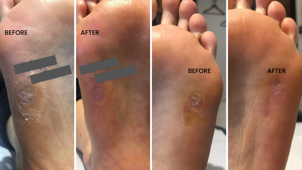 Plantar Wart Removal USA