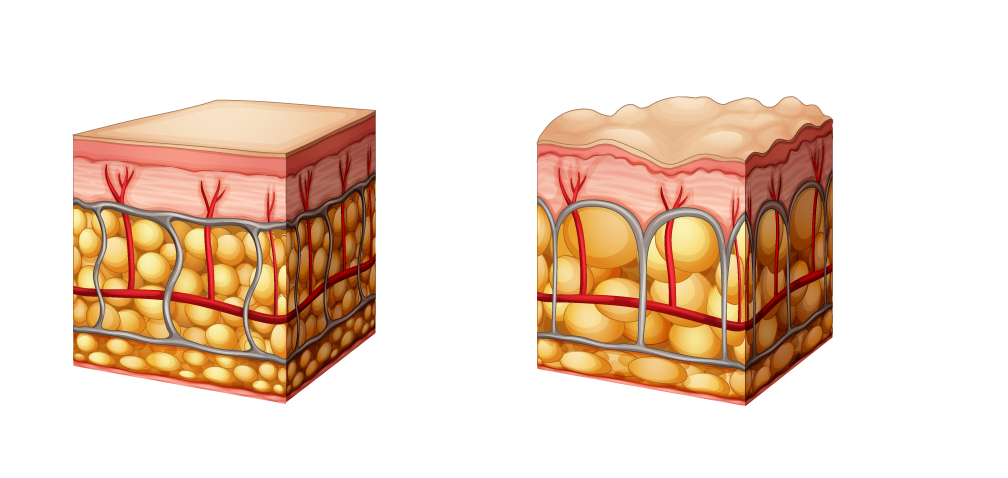 Cellulite Skin Diagram