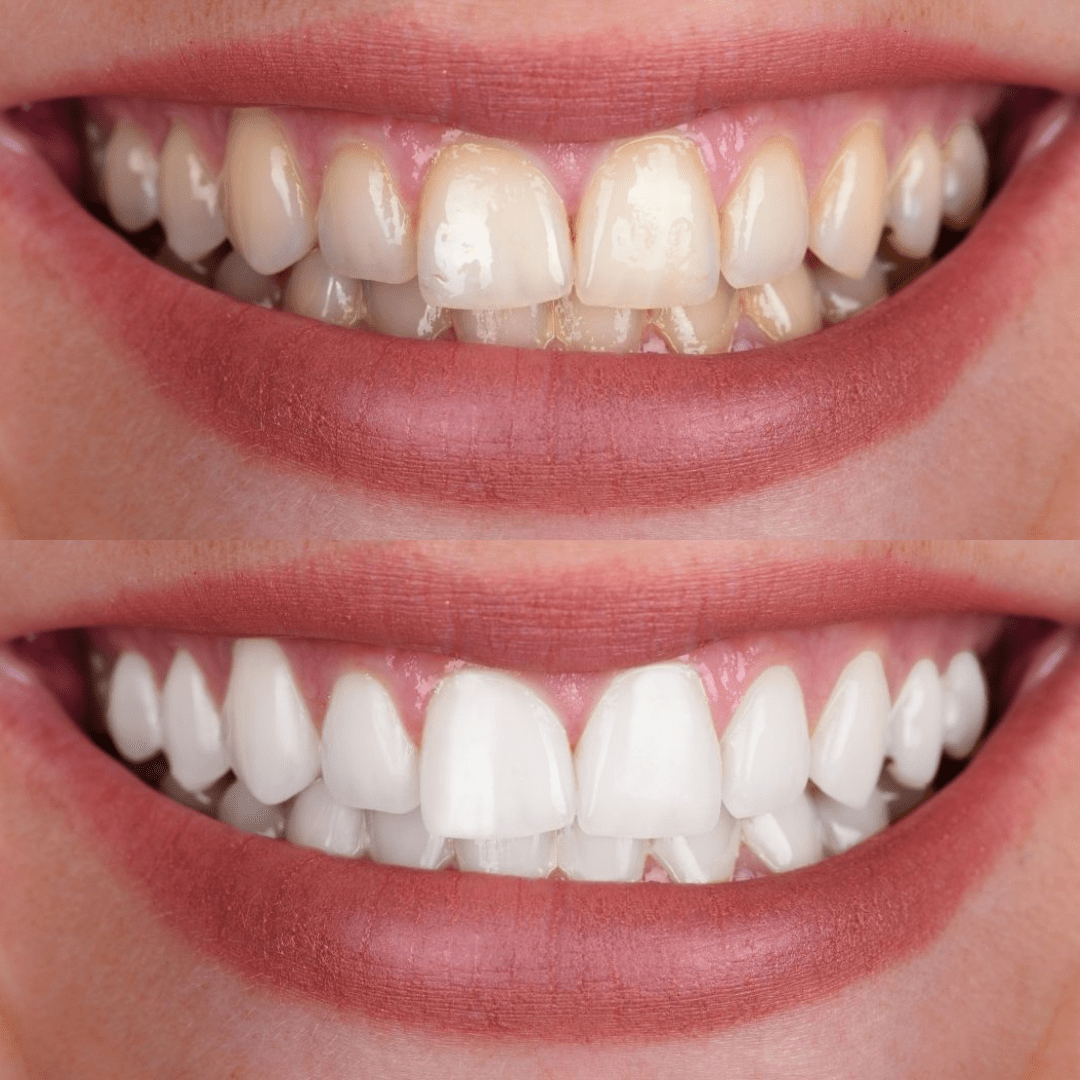 Before and After | All-White Teeth Whitening Marietta GA