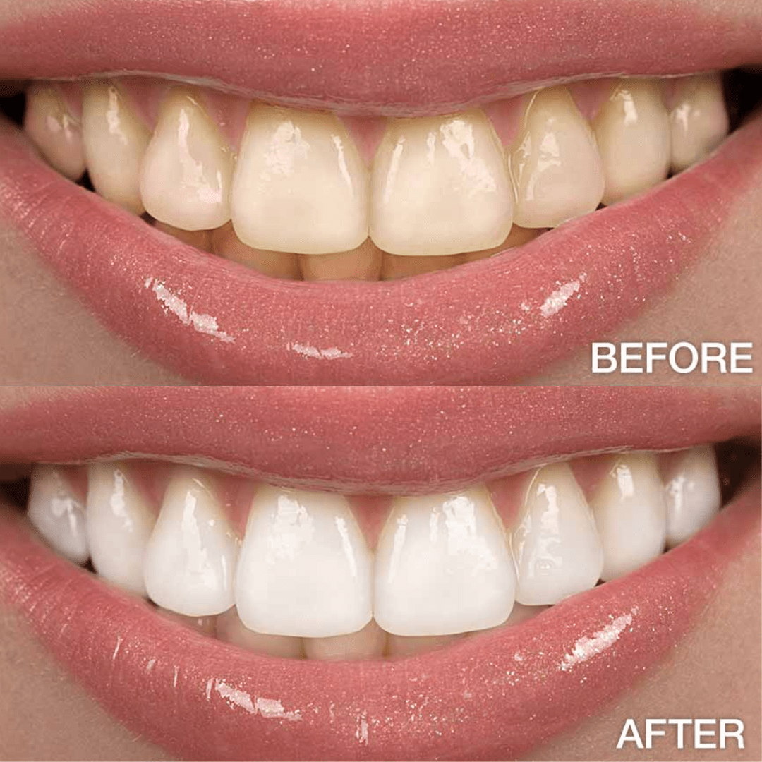 Before and After | All-White Teeth Whitening Marietta GA