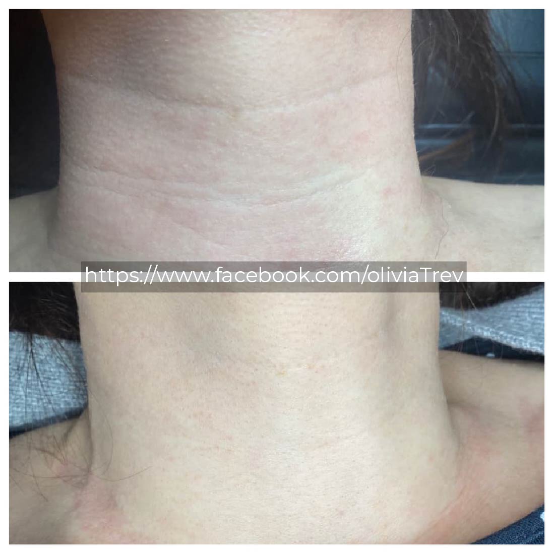 PLAXEL plasma fibroblast pen before and after photo