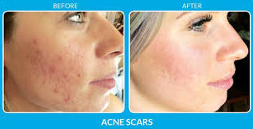 Before and after picture of woman who received acne treatment 