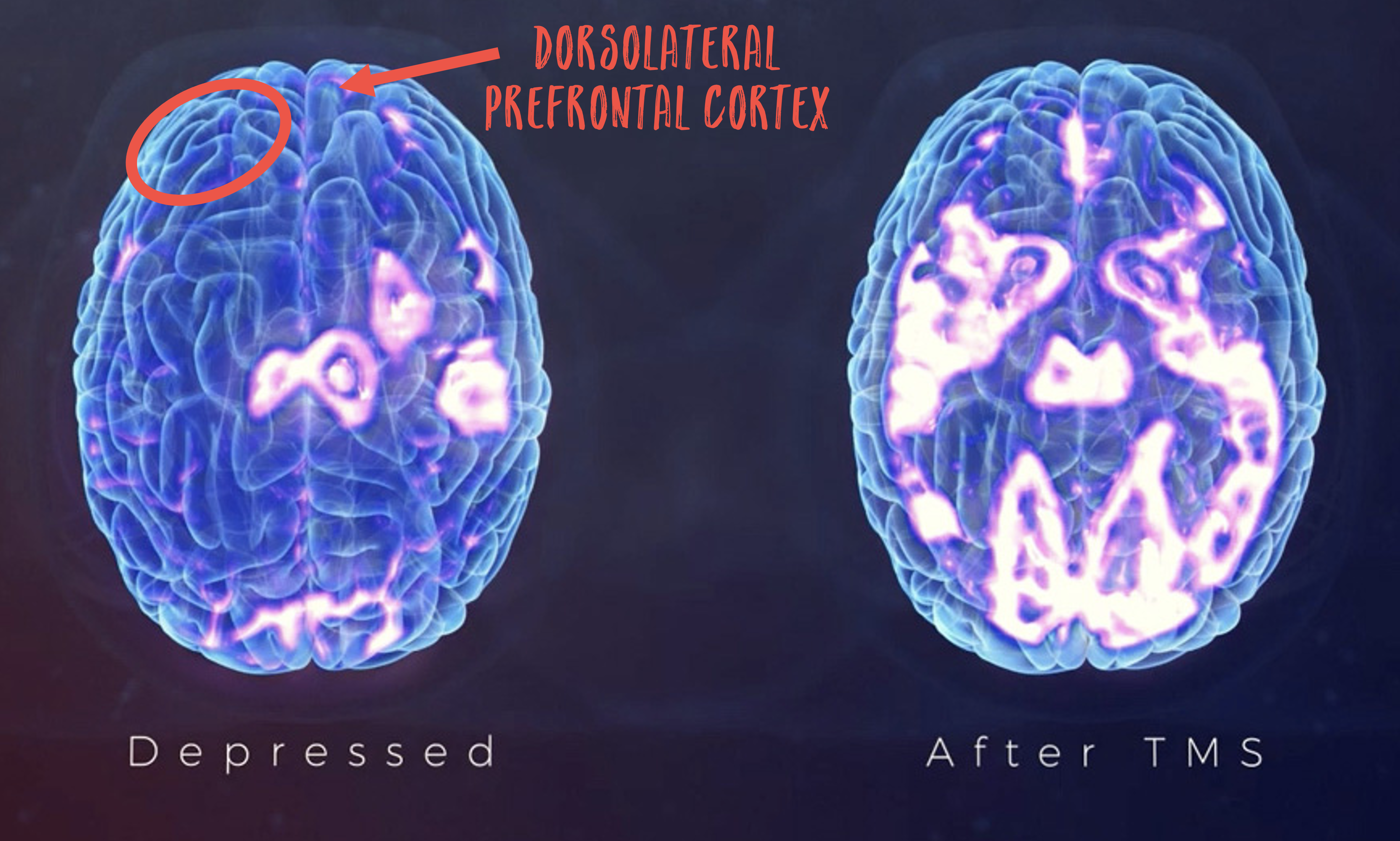 TMS Before and After Brain Scan