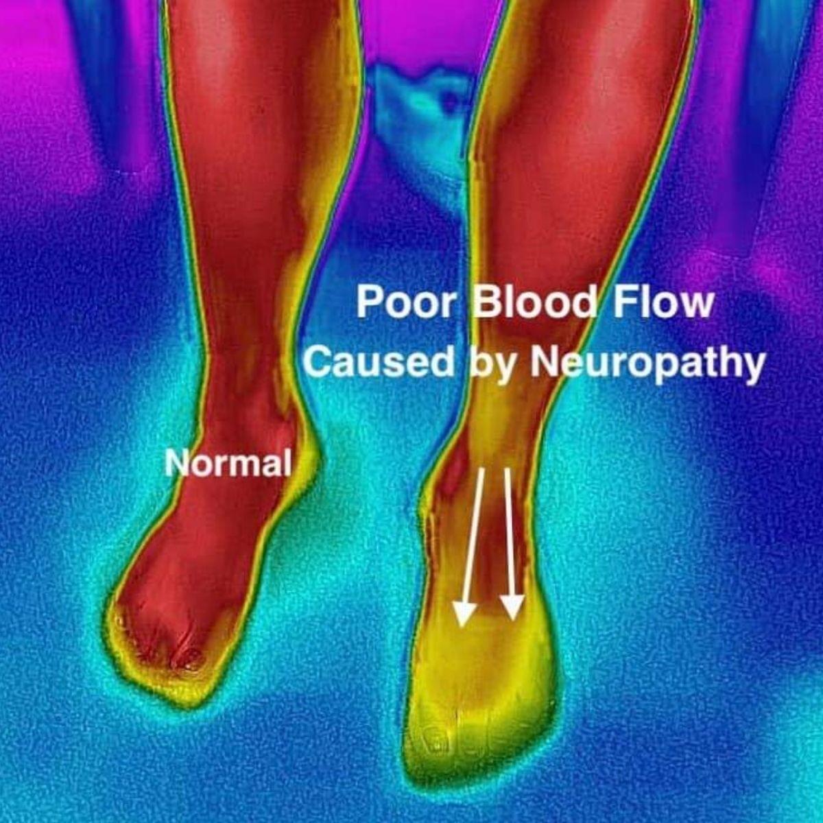 Neuropathy Treatment Breakthrough