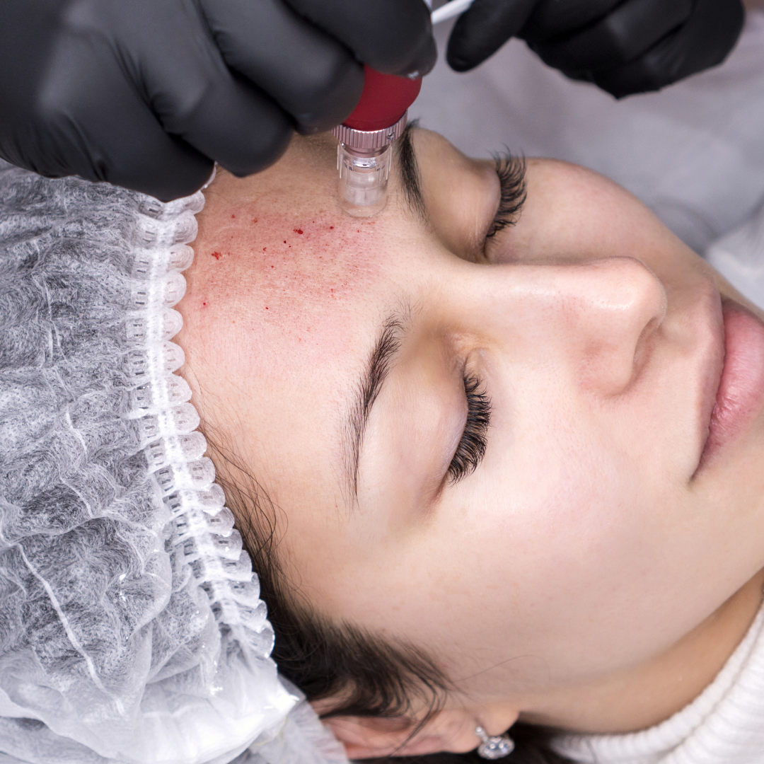 woman getting pricked thoulsands of of times be a skinpen for a rejuvenation micro needling treatment